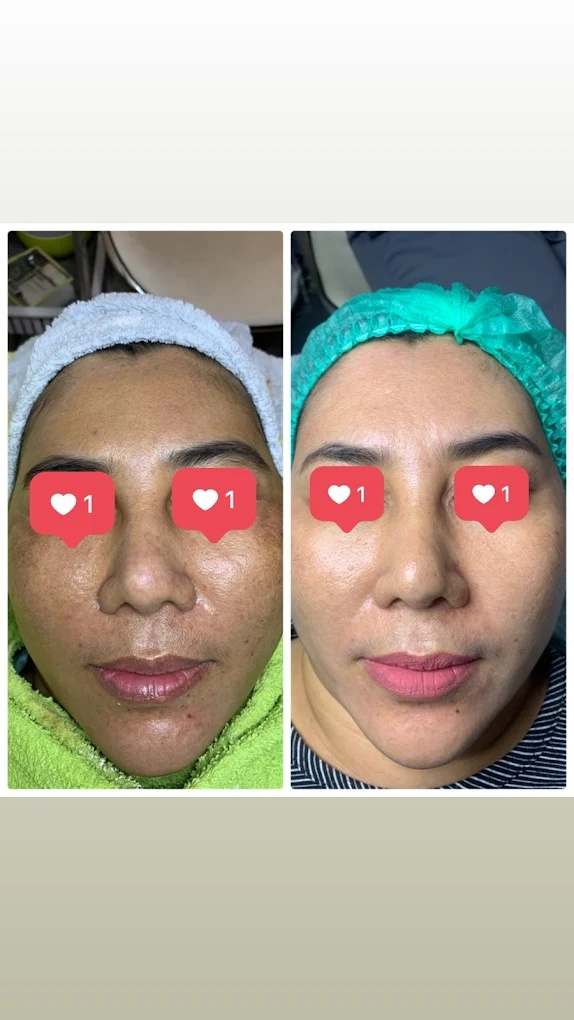 Hasil sebelum dan sesudah perawatan kulit wajah dr. NaZ Aesthetic Clinic